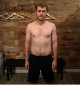 A PTLDN Body Transformation before photo